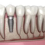 Why Experience Matters With Complex Tooth Replacement
