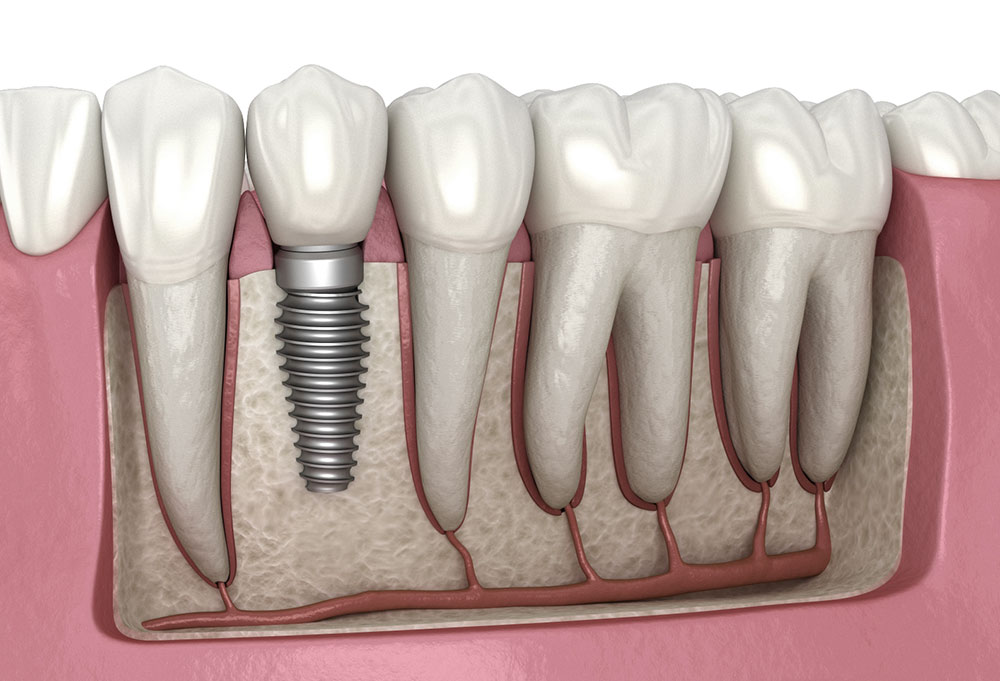Why Experience Matters With Complex Tooth Replacement