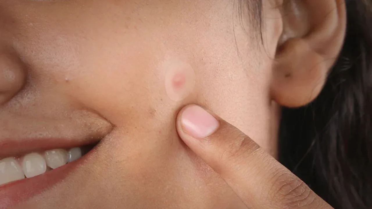 How to Tell Whether You Have Acne Marks or Actual Scarring