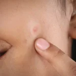 How to Tell Whether You Have Acne Marks or Actual Scarring